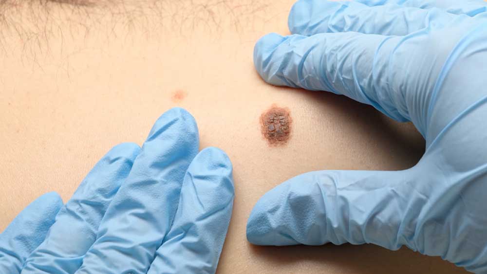 Melanoma, una nuova strategia per potenziare il sistema immunitario prima dell&rsquo;intervento